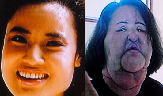 Mujer se inyecta aceite de comer y su rostro se vuelve monstruoso