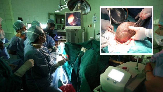 Lambayeque: Extirpan tumor con vellos a mujer en hospital de Essalud