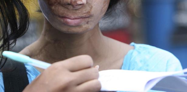 India: Atacan a mujer con ácido horas antes de su boda