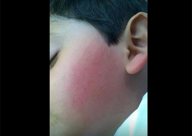 Maestra de kinder golpea a niño de 4 años y le revienta su oído