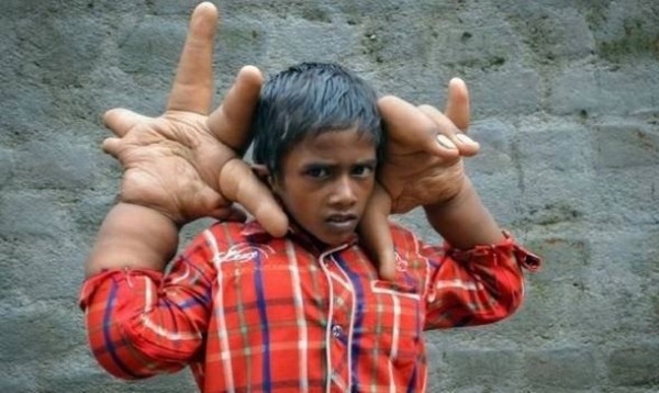 India: Niño sufre rara enfermedad que hace crecer sus manos