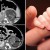 Una bebé nace “embarazada” de gemelos en Hong Kong