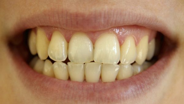 Si se quiere blanquear los dientes, lo ideal es acudir a un especialista y no caer en publicidad engañosa. | Fotógrafo: Getty Images